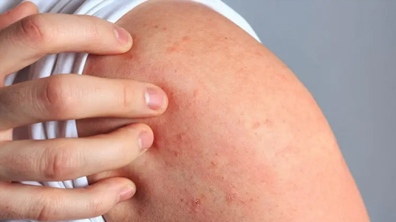 সান অ্যালার্জি কি এবং কেন হয়?