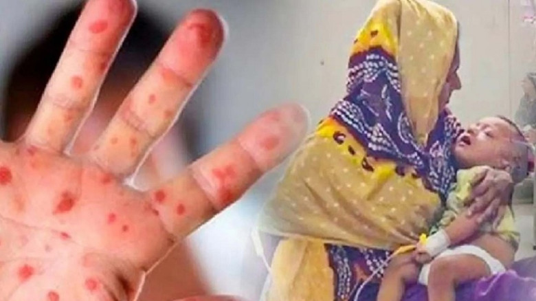 হামের উপসর্গে ২৪ ঘণ্টায় আরও ১০ শিশুর মৃত্যু, হাসপাতালে ভর্তি